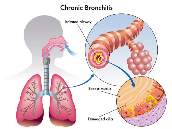 chronic bronchitis