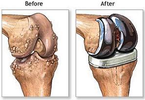 knee joint replacement